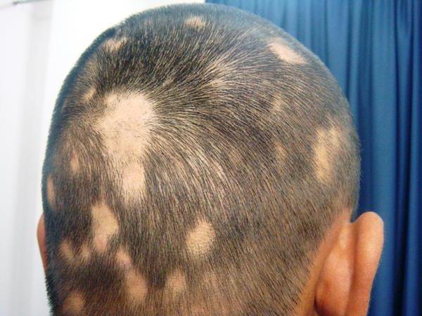 Çocuklarda Alopesi areata