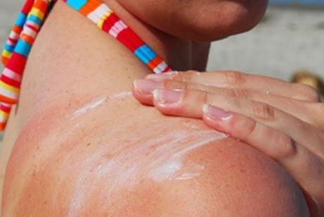 Güneş yanığı için hangi yol daha iyi - güzel ve sağlıklı cildin sırları