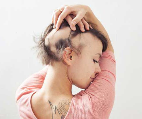 kadın fotoğrafları alopesi 