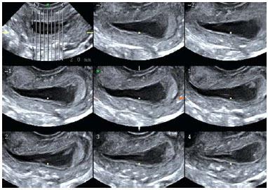 Endometriyum döngüsü tarafından norm sınırları içerisinde ve sapma durumunda