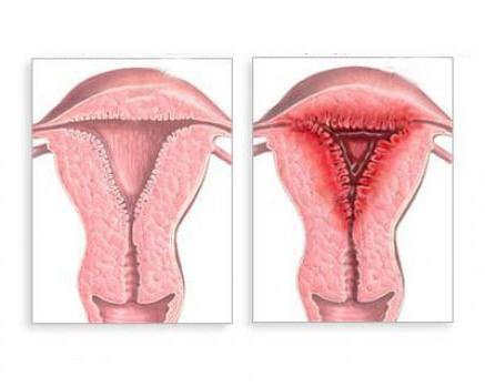 Endometrit nedir 