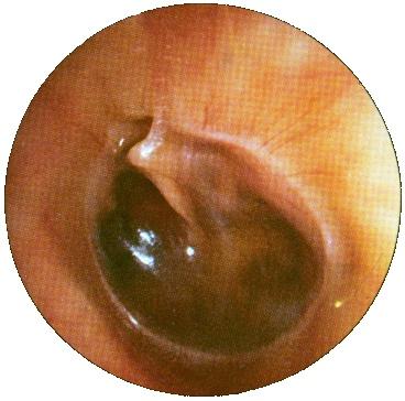 Ortalama otitis catarrhal