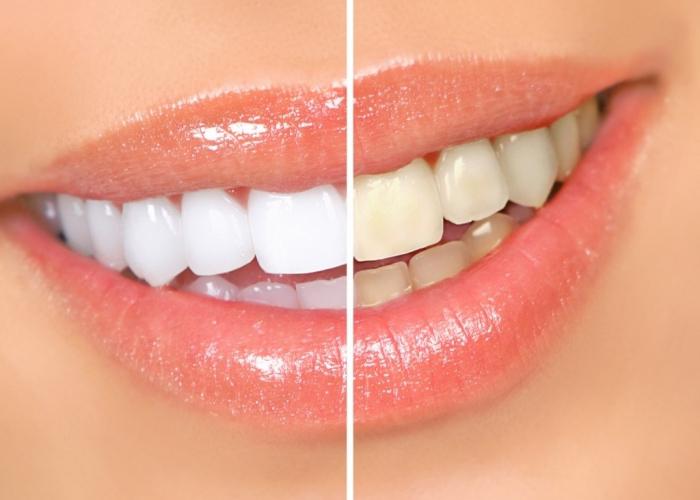 Hidrojen peroksit kullanmanın olağandışı bir yolu: diş beyazlatma